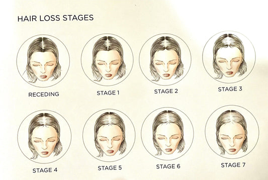 Stages of Hair Loss - Image Maker Wigs Online